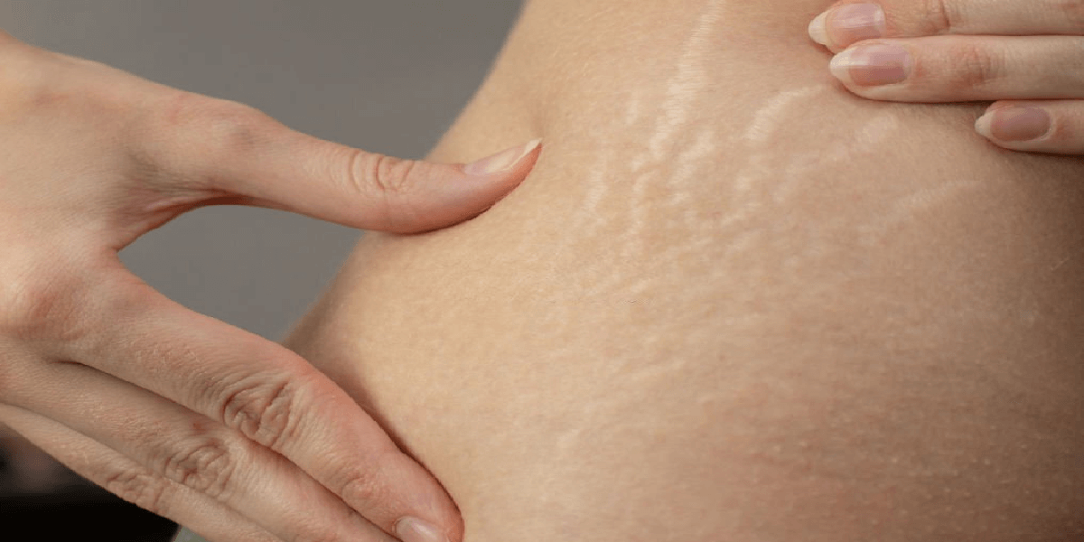 Stretch Marks for Pregnancy